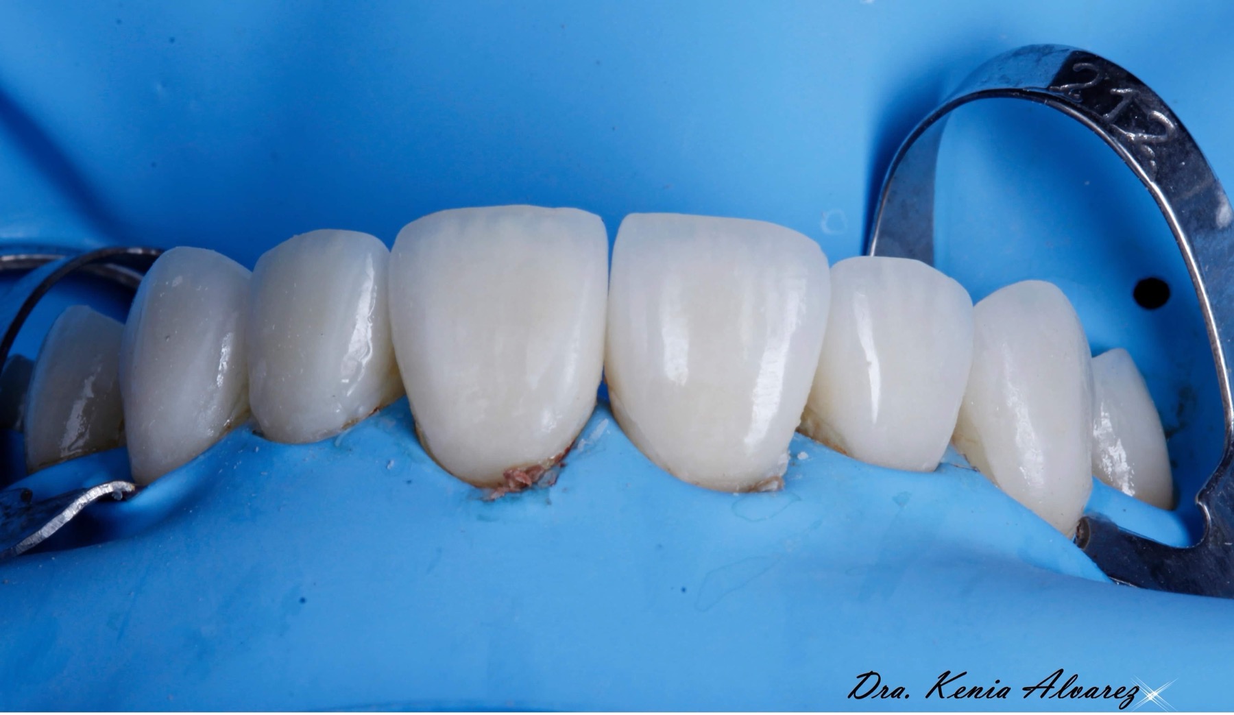 Procedimiento de carillas dentales realizado por la Dra. Kenia Alvarez